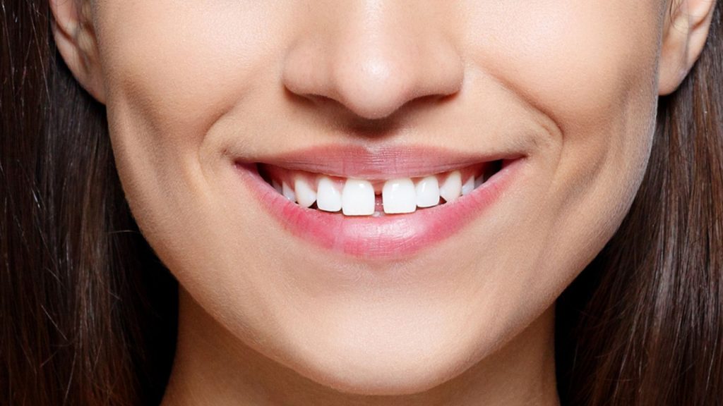 How To Reduce Gap Between Teeth Naturally At Home