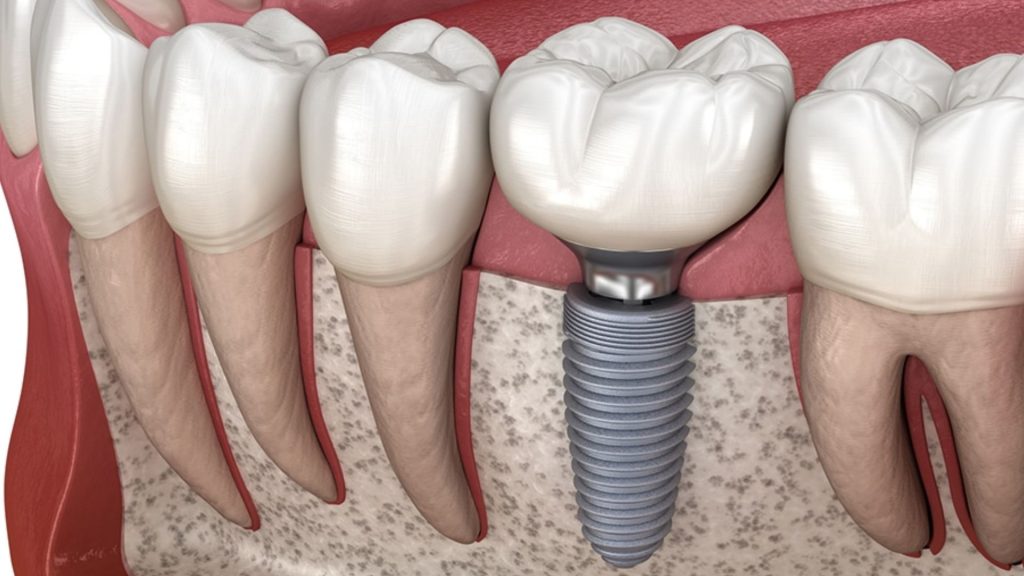 Dental-Implants-1024x576