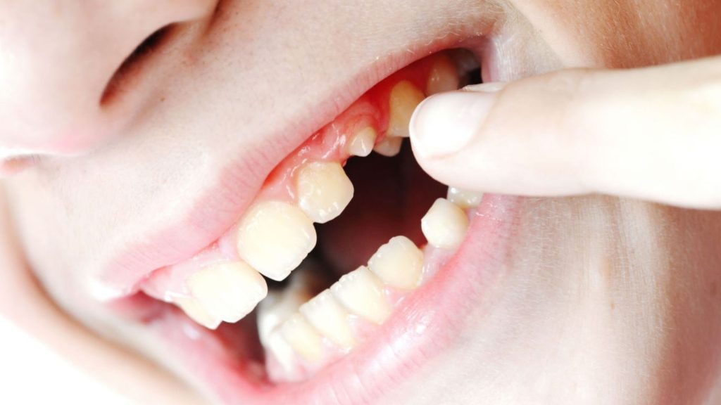 How To Know If The Tooth Root Is Still In The Gum