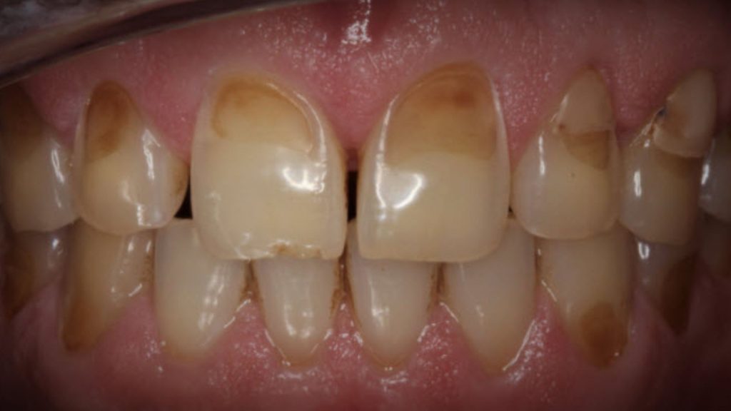 Tooth Enamel Loss: Pictures Of Teeth Without Enamel 