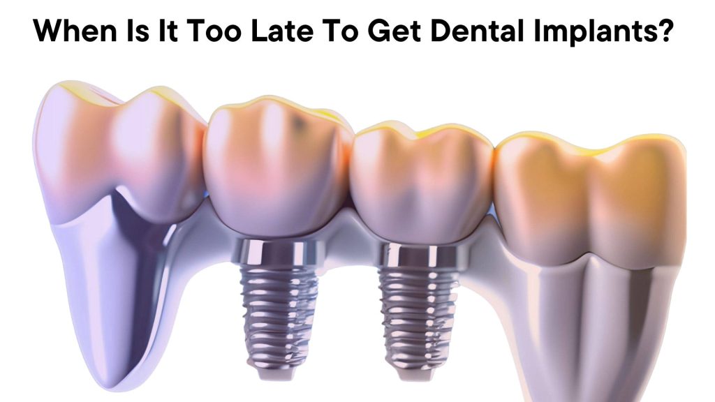 When Is It Too Late To Get Dental Implants