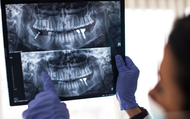 What is A Dental Implant?​
